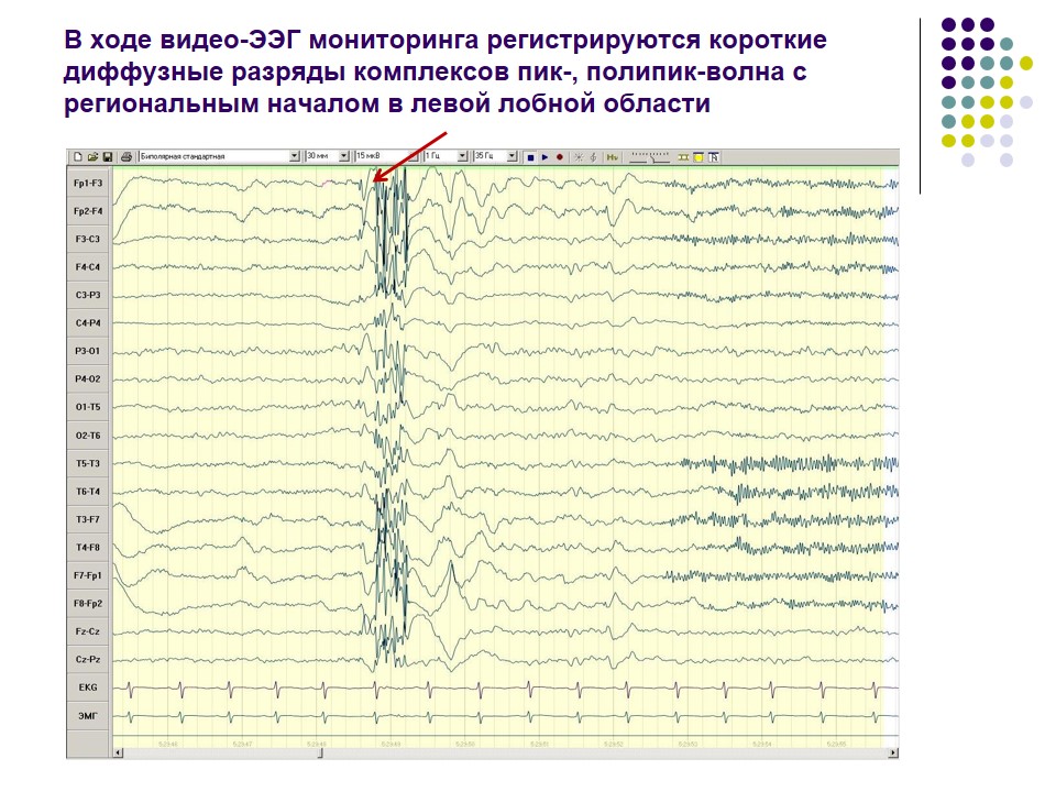 Диффузная активность. Комплексы пик волна на ЭЭГ. Комплекс острая медленная волна на ЭЭГ. ЭЭГ пароксизмальная активность пик волна. Острая волна медленная волна на ЭЭГ.